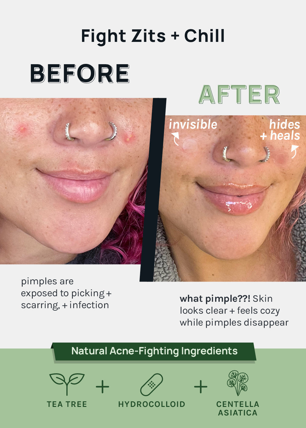AOA Invisible Acne Patch (15 patches)