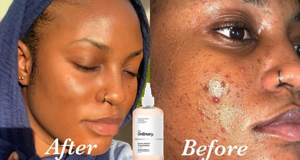 The Ordinary Glycolic Acid 7% Toning Solution