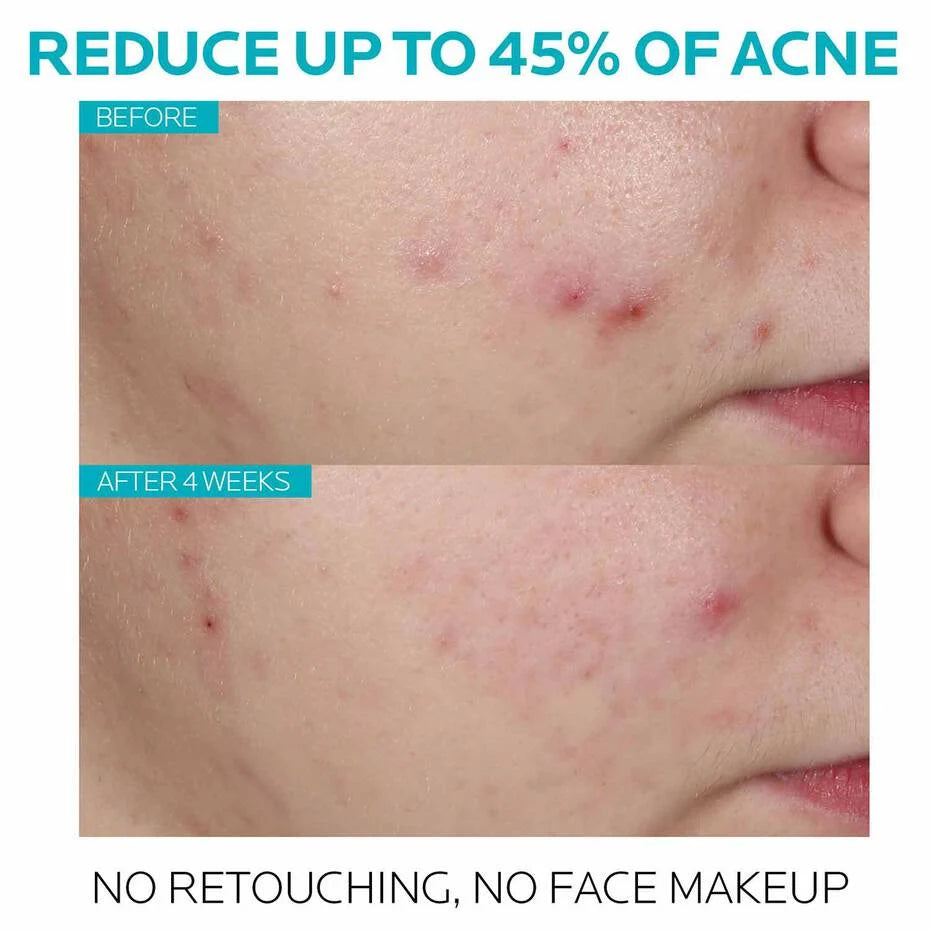 Suero Effaclar Ácido Salicilico Acné Treatment La Roche Posay